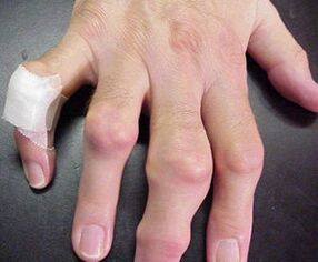 Fingers with joint defects cause pain