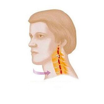 Vertebral syndrome with cervical osteochondrosis