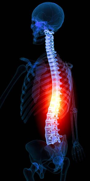 osteochondrosis of the thoracic spine