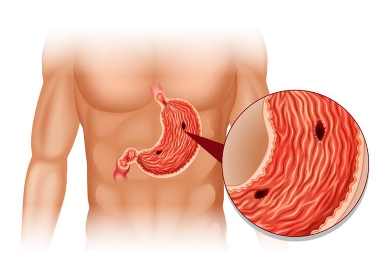 ulcer as a cause of pain under the left back behind