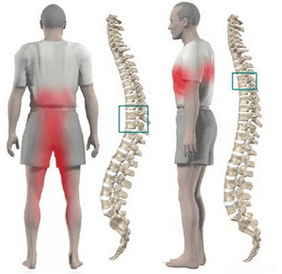 low back pain in thoracic osteochondrosis