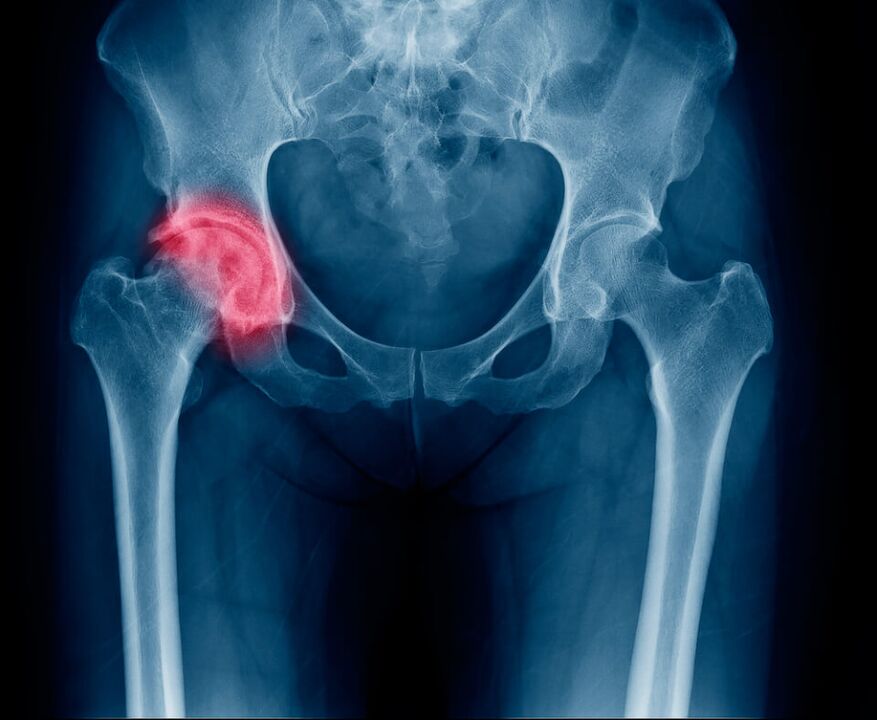 Femoral neck fracture causing pain radiating down the leg