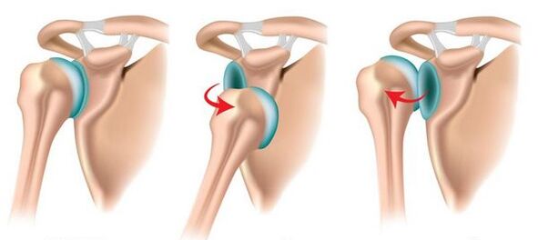 Anterior and posterior dislocation of the shoulder joint, which leads to the development of arthrosis