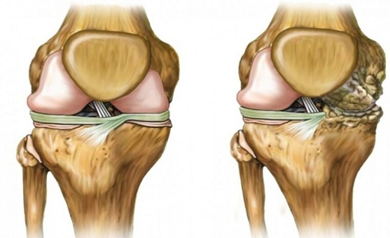 Affected by a combination of healthy and arthrosis