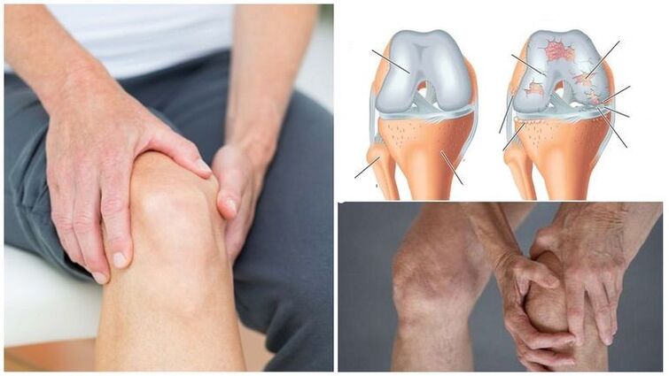Riot's knee joint symptom of knee pain