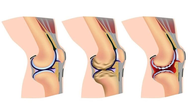Stages of deformation in knee joint for Arthosis