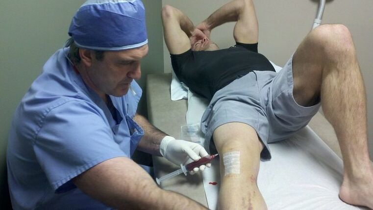 Treatment of arthrosis of knee combination