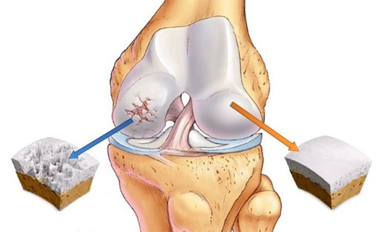affected by normal cartilage and arthrosis