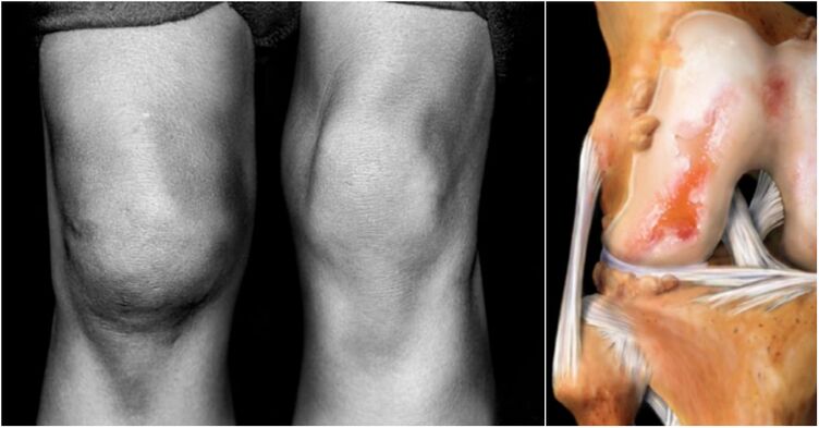 the arthra of knee joint and joint combination