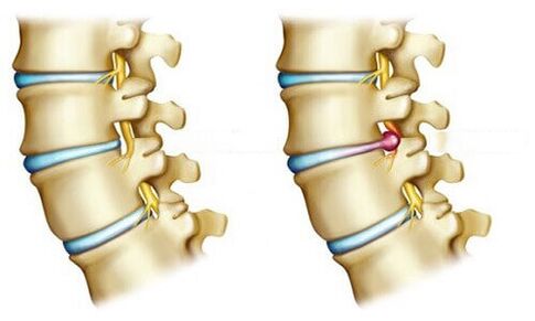 A healthy disc and a herniated disc