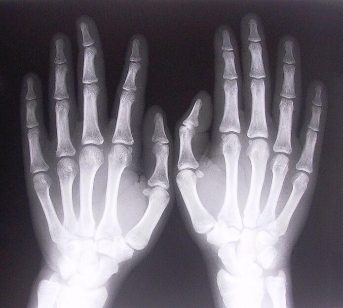 X-ray as a method for the diagnosis of pain in the joints of the fingers