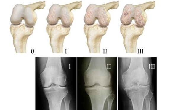methods of diagnosis of knee arthrosis